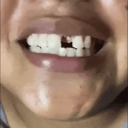 SMILEFORM PRO 🦷 | GRÁNULOS MOLDEABLES • OFERTA POR TIEMPO LIMITADO
